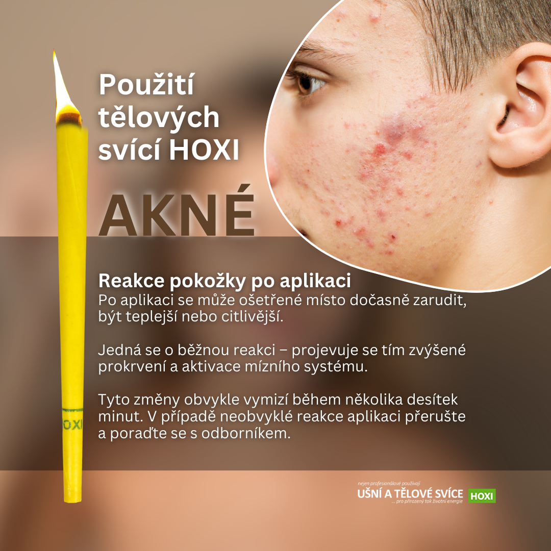 Použití tělových a ušních svící HOXI při akné